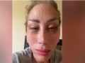  صوت الإمارات - نجمات تعرّضن إلى التشوه بسبب عمليات التجميل آخرهن ريهام سعيد وإليسا